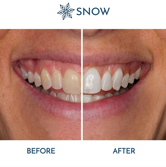 SNOW Teeth Whitening Kit with LED Light | Complete at Home Whitening System - Picture 6 of 6